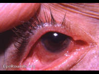 trachoma with symblepharon
