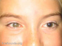 Tractional Retinal Detachment in Norrie's disease