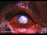 Ulcus serpens/hypopyon ulcer/abscess of cornea