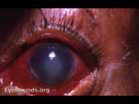 phacolytic glaucoma due to leaking Morgagnian cataract