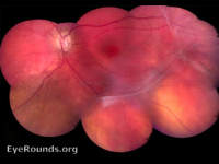 juvenile x-linked retinoschisis