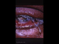 post cataract surgery panophthalmitis