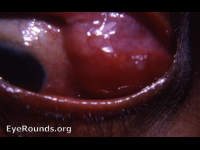 Lacrimal gland tumor