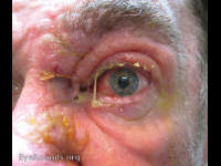 Herpes Zoster