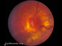 von Hippel Lindau (VHL) - retinal hemangioblastoma