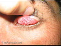 Vernal Keratoconjunctivitis