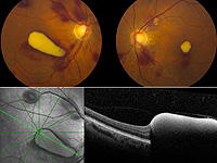 Valsalva retinopathy