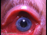 viral keratoconjunctivitis