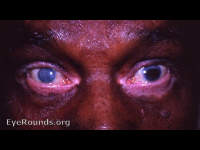 Vogt-Koyanagi-Harada Syndrome - a textbook case