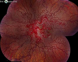 Wyburn mason syndrome