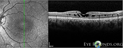 X-linked retinoschisis (XLRS)