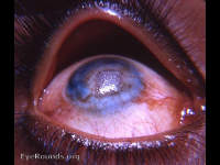 xerotic plaque in center of neovascularized corneal leukoma