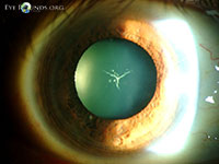 Y-suture Cataract