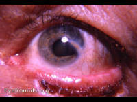 perforating corneal injury with iridectomy, repaired