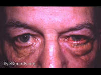 Ziegler cautery procedure for spastic entropion, post-op