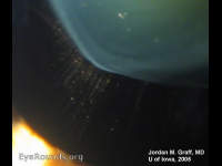 Zonules of Zinn