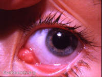 caruncle: abscess of caruncle