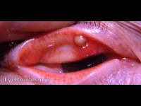 abscess of meibomian gland