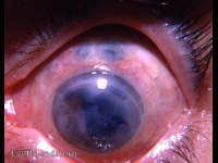 absolute glaucoma, failed iridencleisis, and tattooed cornea