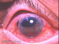 absolute glaucoma following extraction of subluxated cataract