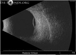 Acquired peripheral retinoschisis Acquired peripheral retinoschisis