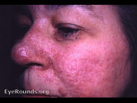 tuberose (tuberous) sclerosis