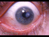 adherent leukoma
