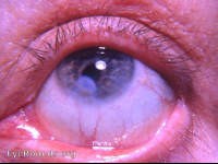 adherent leukoma