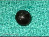 Mature Cataract