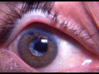 Aftercataract: following a planned intracapsular cataract extraction in 1977