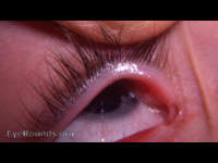 Congenital absence of the lacrimal puncta