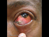 chemical burn