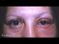 allergic blepharitis