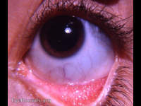 allergic follicular conjunctivitis
