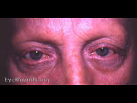 alopecia totalis with loss of eyebrows and eyelashes
