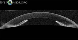 Angle closure glaucoma following Descemet's Membrane Endothelial Keratoplasty (DMEK)