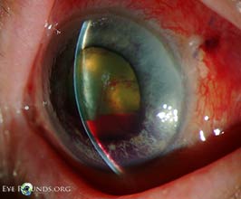 angle-closure glaucoma due to intraocular gas expansion