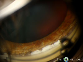 Angle recession and cyclodialysis after blunt trauma