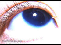ncomplete aniridia