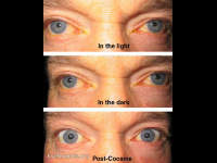physiologic anisocoria