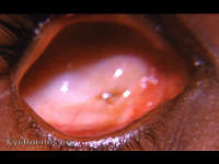 clinical anophthalmos
