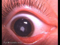 Anterior polar cataract