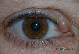 Apocrine hidrocystoma