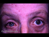 atopic dermatis with cataracta complicata