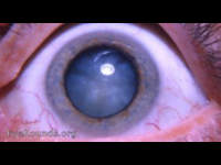 Intumescent cataracta neurodermatica
