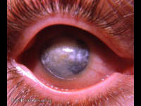 atrophia bulbi with leukomatous cornea that is showing fatty and calcium infiltration.