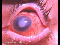 Atrophia bulbi