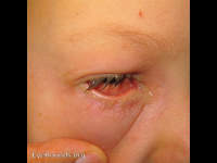 bacterial conjunctivitis