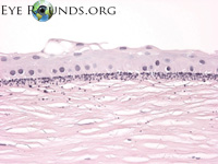 Band Keratopathy