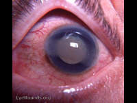 band keratopathy